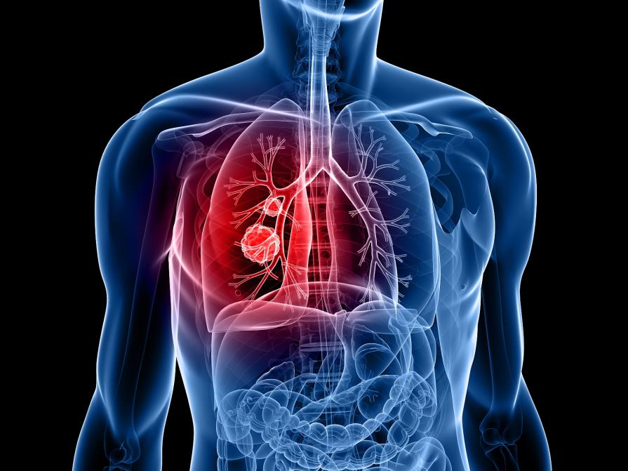 肺癌图片
